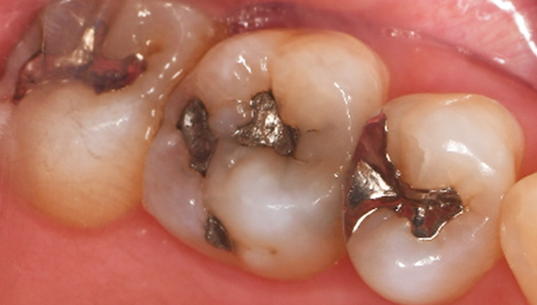 セラミックインレーの症例