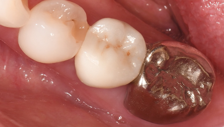 ジルコニアクラウンの症例