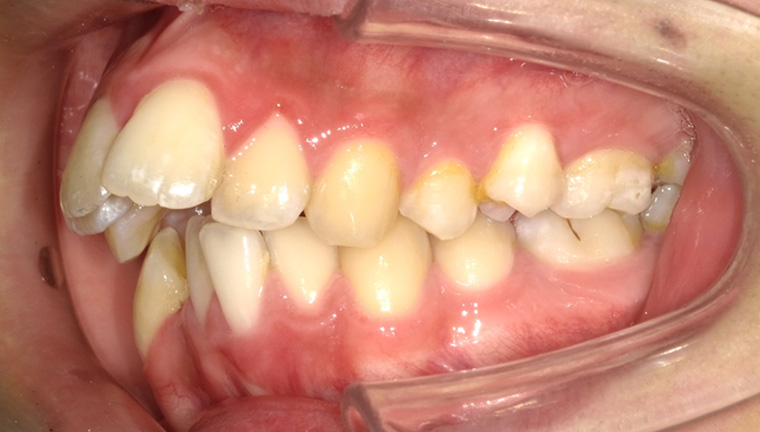 【矯正治療】上顎前突症の症例