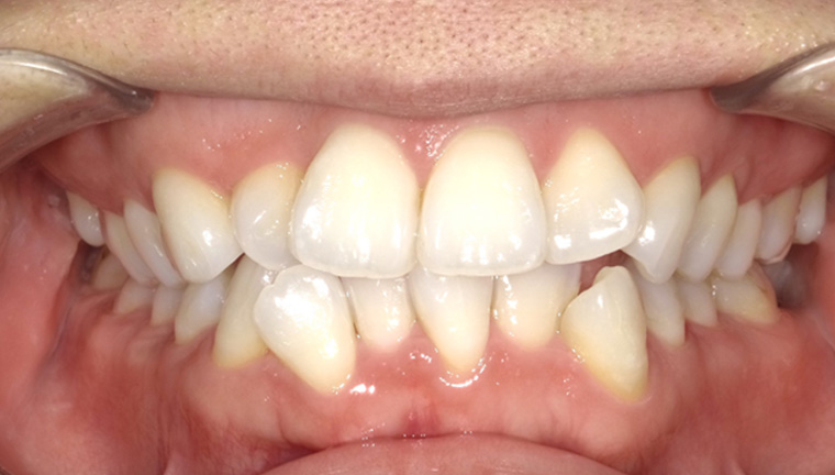 【矯正治療】叢生の症例