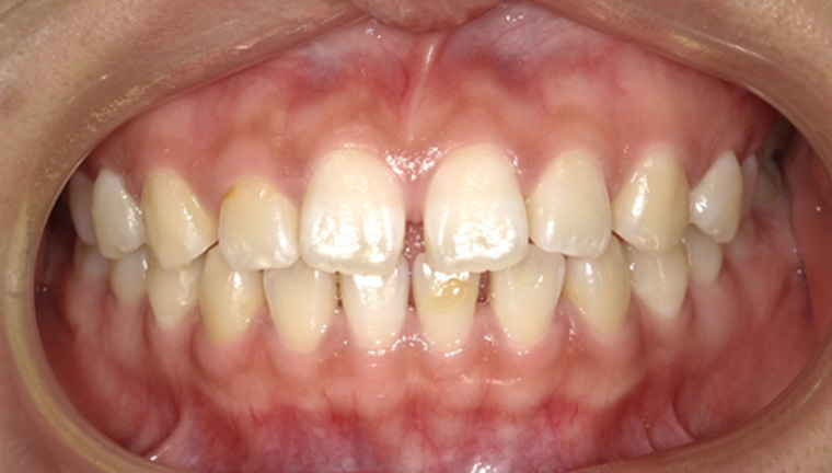 【矯正治療】空隙症例の症例
