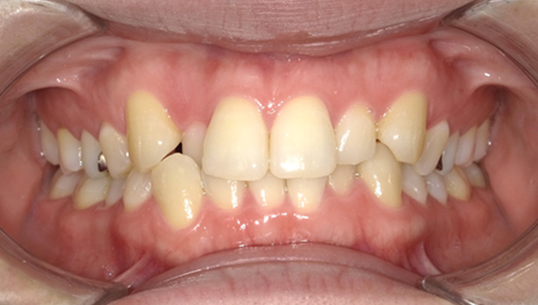 【矯正治療】叢生の症例