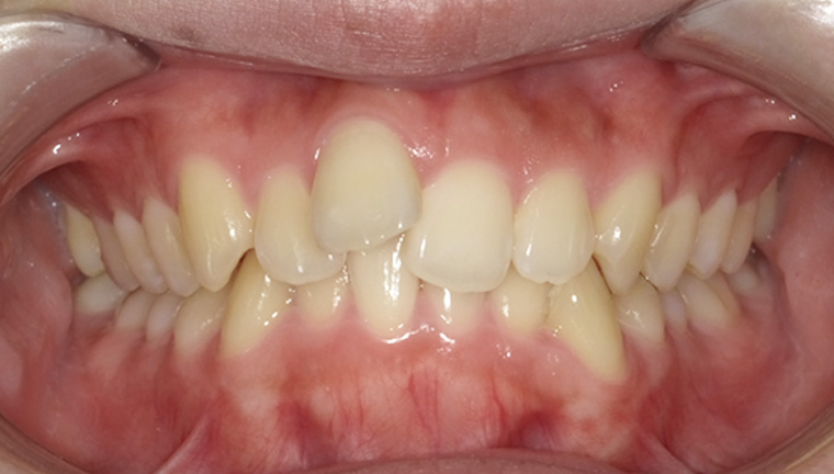 【矯正治療】前突の症例